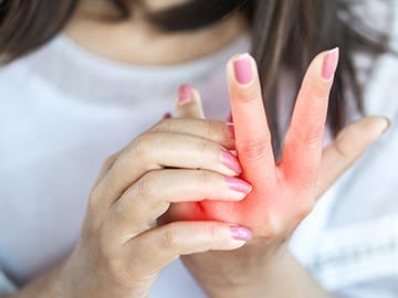 ¿Cómo curar una quemadura?​